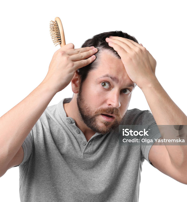 hairloss 2